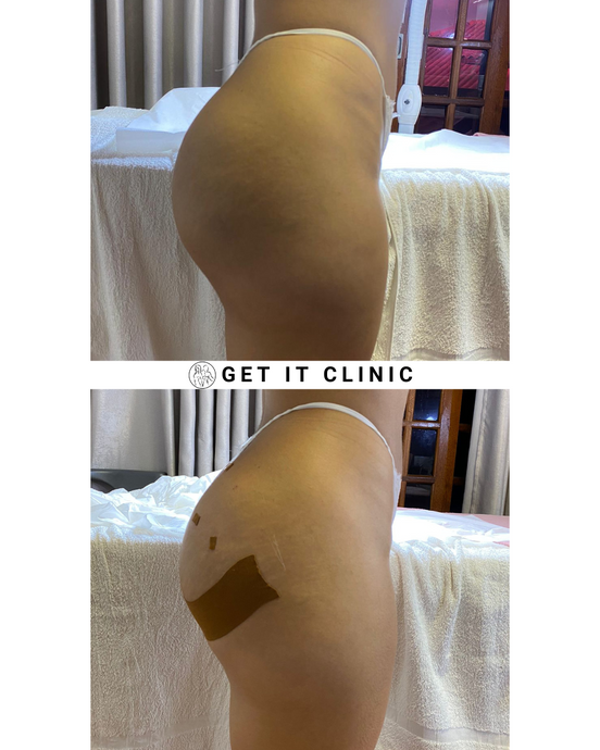 Eleva o Teu Bumbum com o Tratamento Bumbum Up da Get It Clinic!