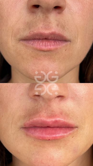 Preenchimento: e se não ficar natural?